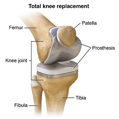 Get Total Knee Replacement Doctor in Kothrud Pune
